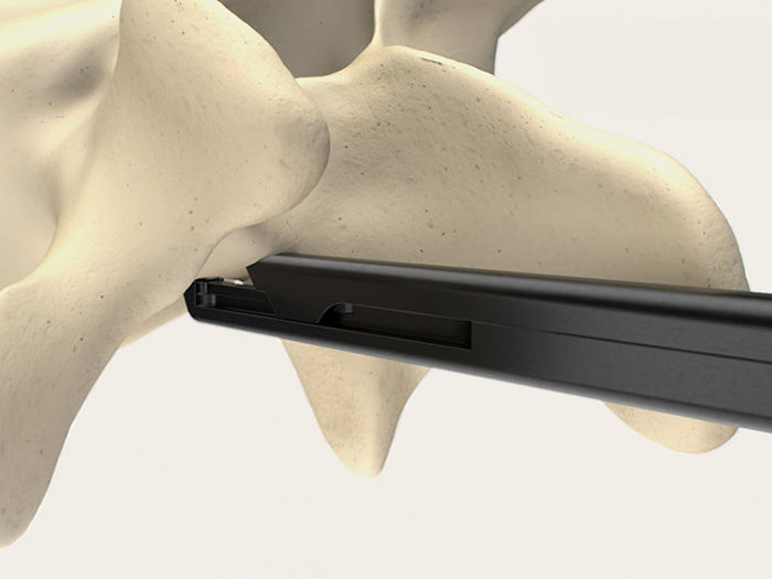 Usage of the SQ.line® KERRISON while cutting  away small sections of bone